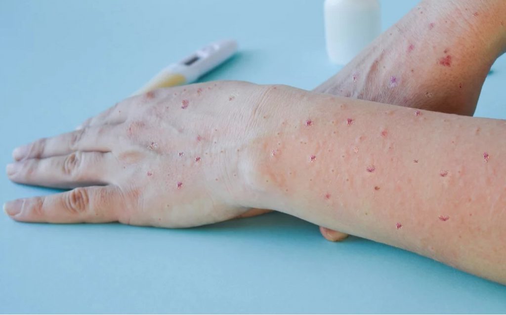 54 κρούσματα Ευλογιάς των πιθήκων σε όλη την Ελλάδα