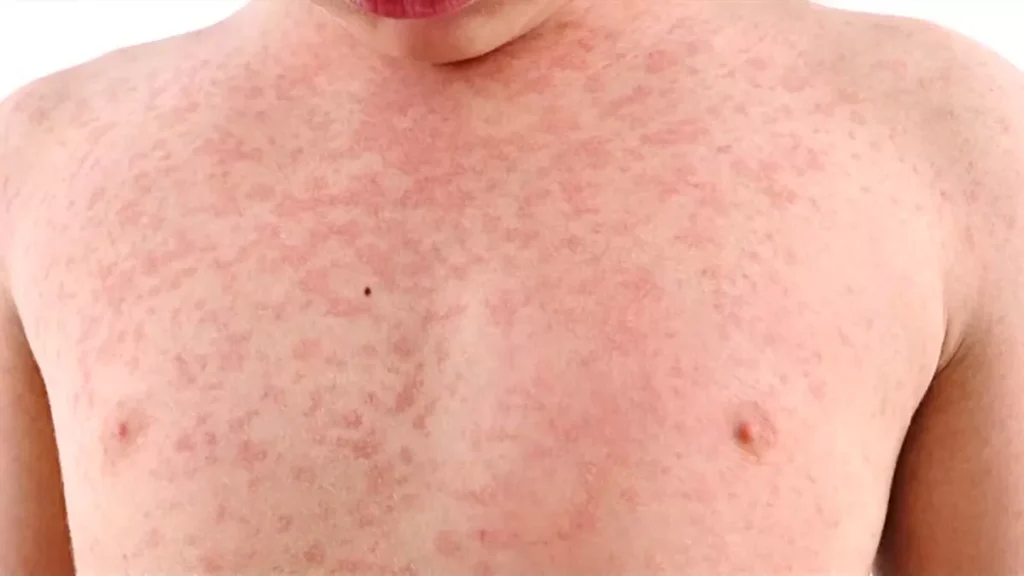 Ιλαρά: Γιατί εκτινάχθηκαν τα κρούσματα στην Ευρώπη – Τι δείχνουν τα στοιχεία για την Ελλάδα