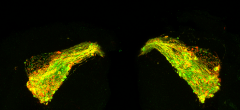 Νέο φάρμακο πολλά υποσχόμενο στη θεραπεία της νόσου Αλτσχάιμερ